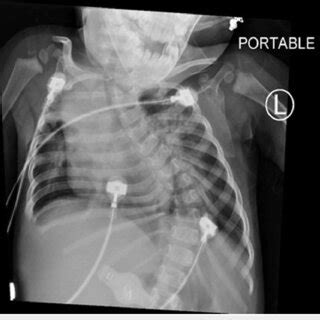 Chest X Ray Portable Of A Patient With Birk Barrel Syndrome Bilateral