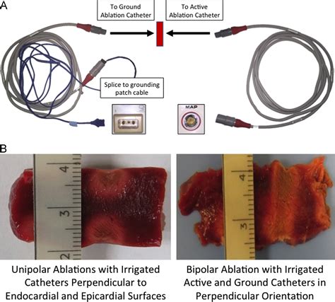 Clinical And Biophysical Evaluation Of Variable Bipolar Configurations