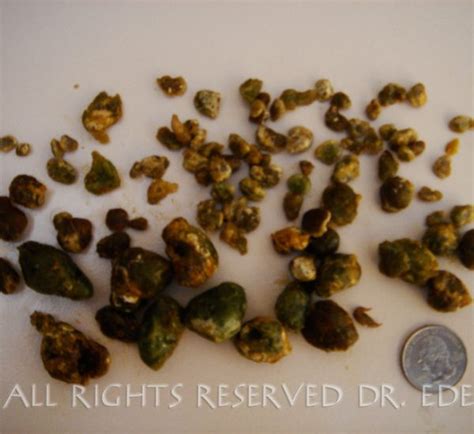 Gallstone Pictures Gallery See Images Of Real Gallstones Passed