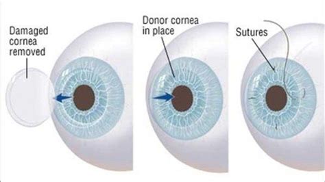 Cornea Transplant Surgery In India Types Cost Hospitals And More