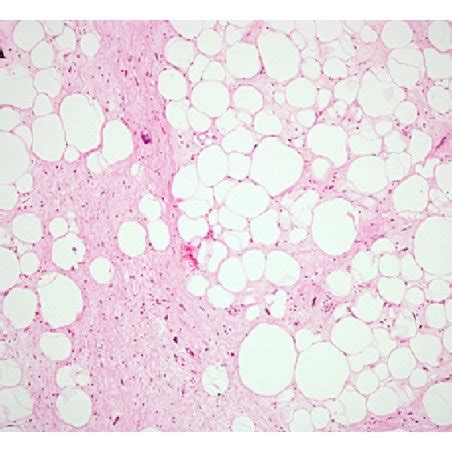 A Well Differentiated Liposarcoma Wdl This Typical Example Shows