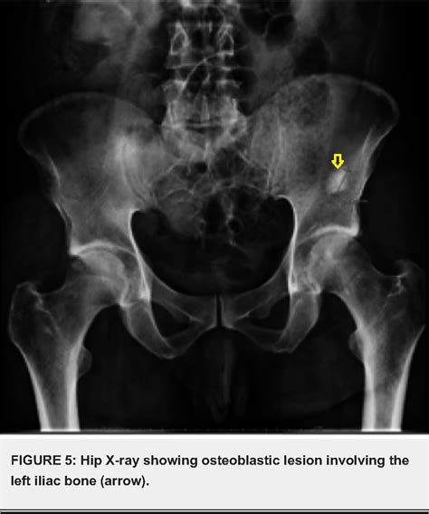 Figure From A Rare Case Of Pulmonary Mucosa Associated Lymphoid