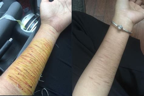 ramai  kelar tangan hukum diri gadis nasihat mangsa depresi