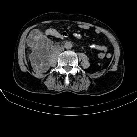 File Hepatic Intra And Retro Peritoneal Hydatid Cysts Radiopaedia