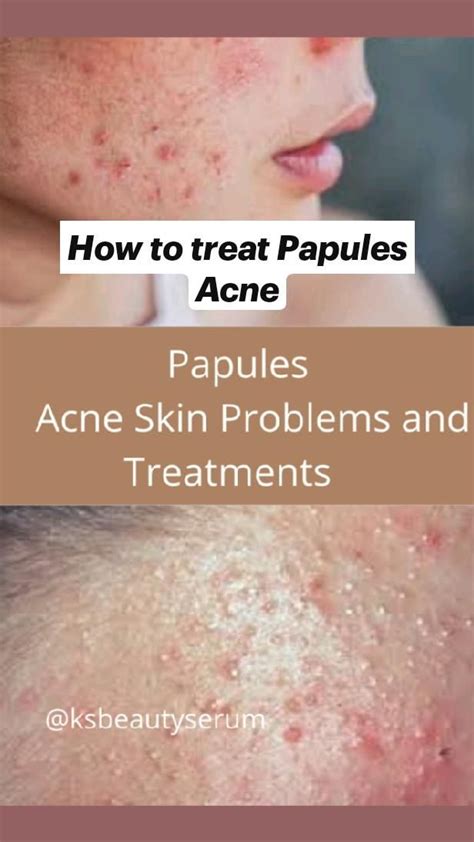 How to treat Papules Acne... in 2022 | Papules acne, Organic skin care ...