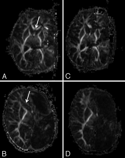 Intraoperative 3-T MRI with DTI. The images show incomplete and further ...