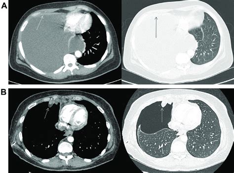 Ct Chest Pleural Effusion