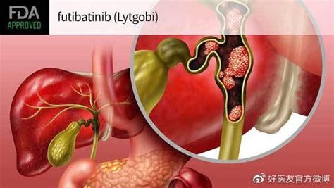 晚期胆管癌，迎来新靶向药lytgobi胆管癌患者缓解率新浪新闻