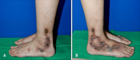 A B The Patient Presented With Localized Erythematous To Violaceous