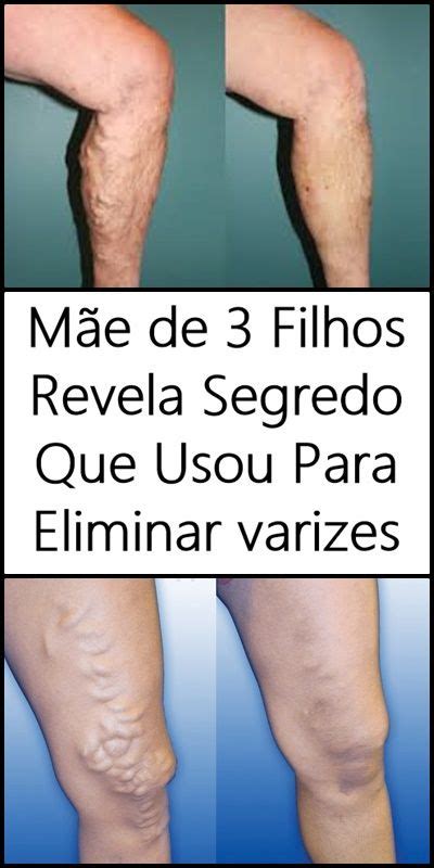 Receita Caseira Para Eliminar As Varizes Das Pernas D17