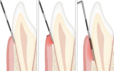 Diagnosi Della Parodontite Ulteriori Informazioni Periodontal Health