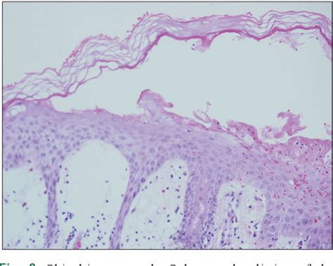 Table 1 From Staphylococcal Scalded Skin Syndrome In A Healthy Adult