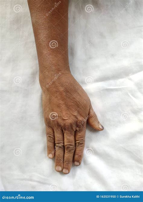 Fracture Dislocations Of The Wrist 3
