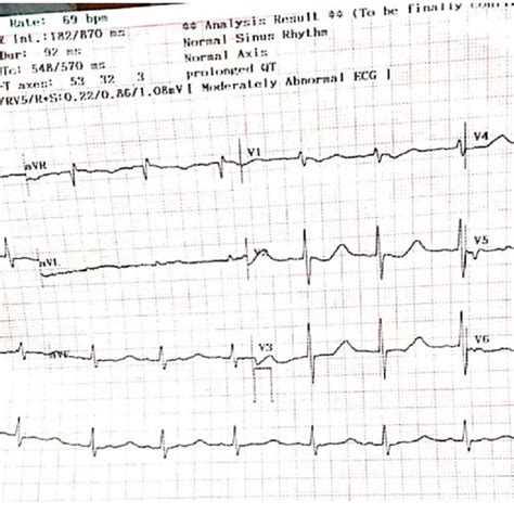 An Electrocardiogram Showed A Normal Sinus Rhythm With Min