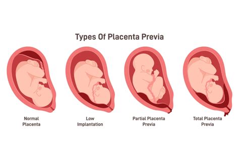 Placenta Previa: Symptoms, Causes And Treatment - Being The Parent