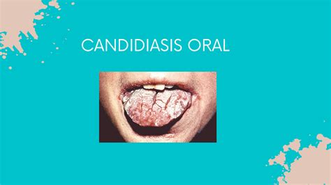 SOLUTION Candidiasis Oral 3 Studypool