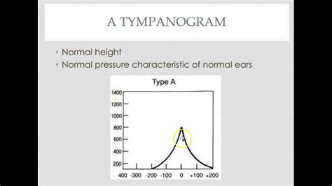 Tympanometry Interpretation Youtube