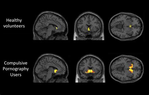 Your Brain On Porn How Porn Consumption Changes Your Brain Structure