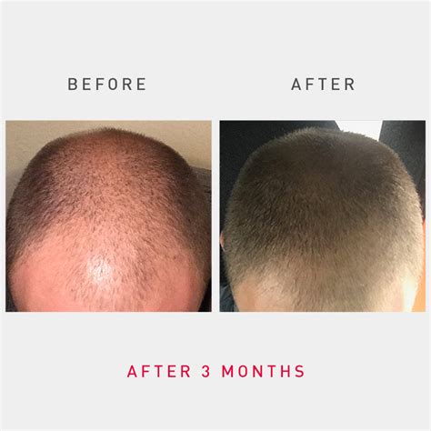 Irestore Laser Hair Growth System Fda Cleared Hair Loss Treatment