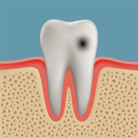 Mancha Nos Dentes Os Principais Tipos Veja Agora Md Odontologia