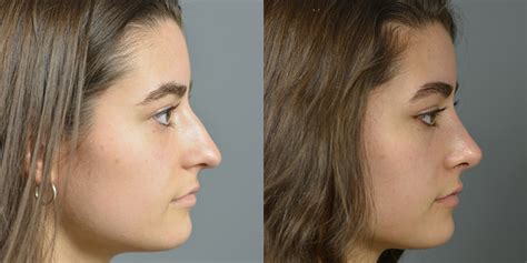 Nose Surgery Before After Patient 33 Dr Marotta