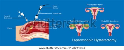 Laparoscopic Hysterectomy Medical Surgical Treat Cervix Ovary Subtotal