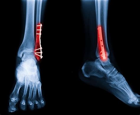 Screws in Ankle Surgery - HealthBeauty123 | Your Health & Beauty Referrence