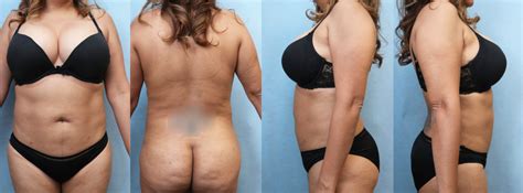 Healing After Liposuction What To Expect Dr Jaz Blog