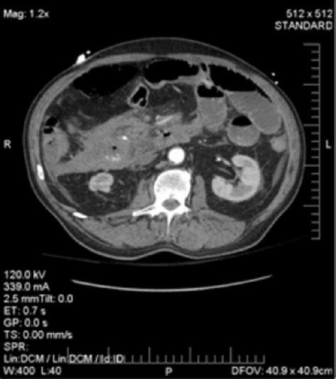 Figure 4 From Inferior Pancreaticoduodenal Artery Aneurysm With