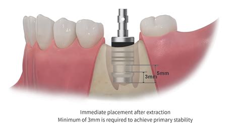 Taper Ultra Kit Hiossen Implant