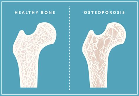 Osteoporosis Clinic Methodist Hospitals