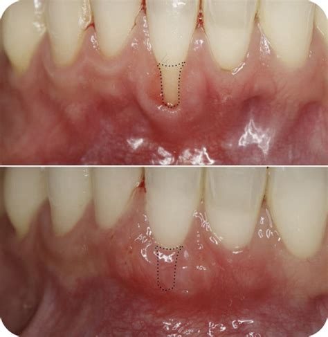 Gum Recession Grafting Periodontist New York City