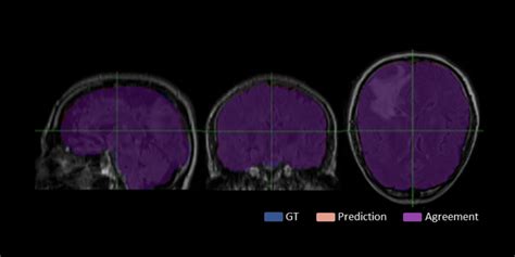 GitHub - CBICA/BrainMaGe: Brain extraction in presence of abnormalities ...