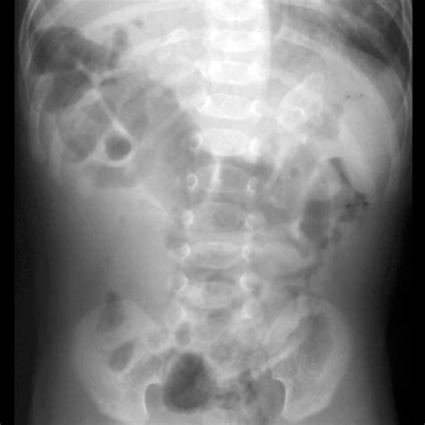 hemorrhage adrenal gland