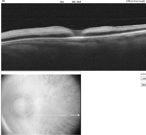 Figure Optical Coherence Tomography Of Macula Statpearls Ncbi