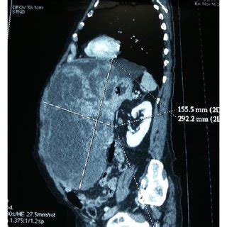 Preoperative Contrast Enhanced Abdominal Ct Scan A The Sagittal