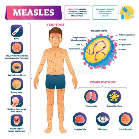 Ejemplo Del Vector Del Sarampi N Enfermedad De Virus M Dica Etiquetada