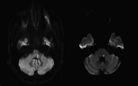 Peripheral Type Facial Palsy In A Patient With Dorsolateral Medullary