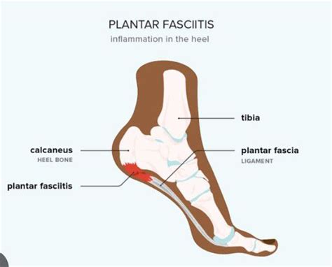 Symptoms of Plantar fasciitis - MEDizzy