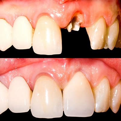 Broken Teeth Repair