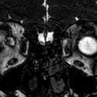 Coronal T2 MRI demonstrates olfactory bulb of male pt 40 ys old shows... | Download Scientific ...