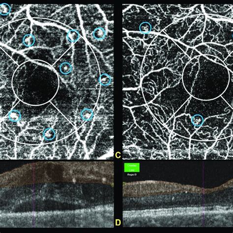 Demonstrates Etdrs Grid Of The Left Eye And Area Labeled In Each