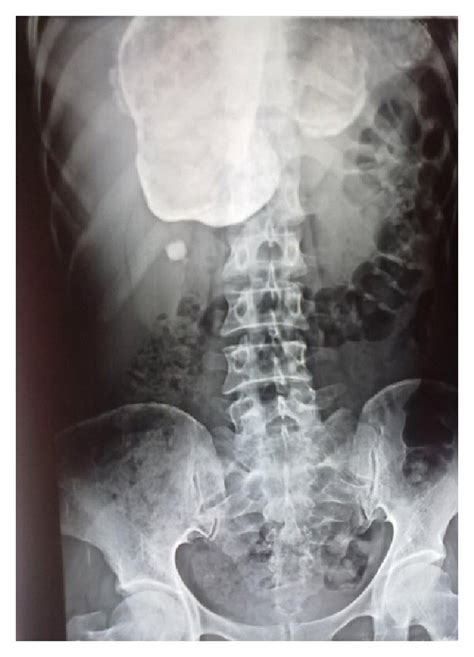 X Ray Showing Calcified Hydatid Cyst Of Liver Download Scientific Diagram