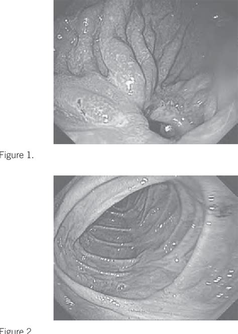 Figure 1 From A Pitfall Of Endoscopic Clipping In The Management Of