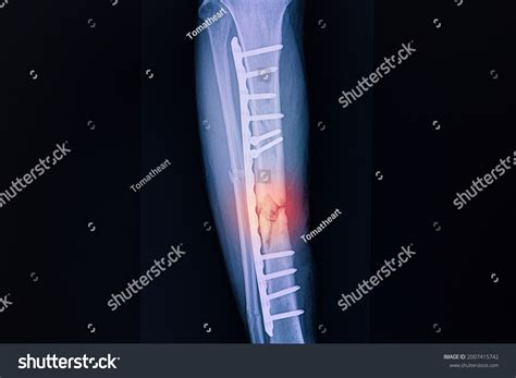 Xray Film Patient Comminuted Fracture Right Stock Photo 2007415742