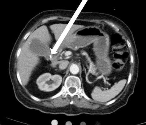 A Case Report On Detecting Porcelain Gallbladder Form Wall Echo Shadow