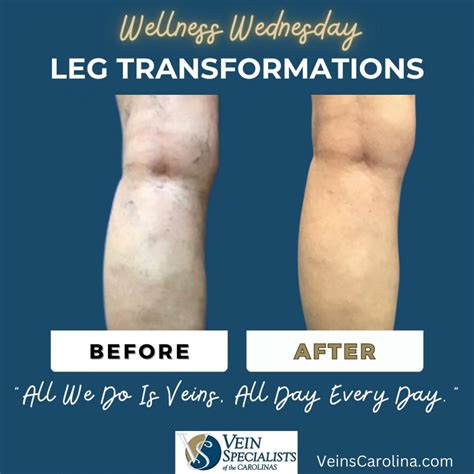 Wellness Wednesday Leg Transformations By Vsc Vein Specialists Of