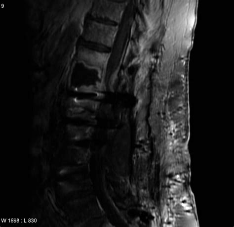 Discitis Osteomyelitis Previous Plif Image Radiopaedia Org