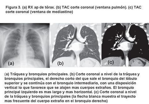 Diagn Stico Por La Imagen De Los Cuerpos Extra Os Alojados En La V A