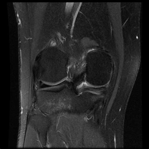 Meniscal Tear Image